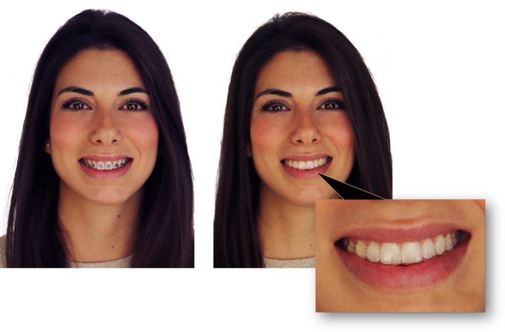 Tratamiento de ortodoncia Invisible Madrid