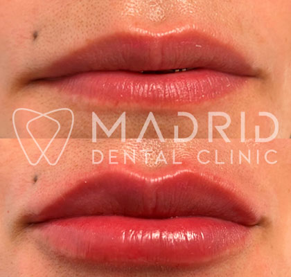aumento y perfilado de labios con acido hialuronico en madrid