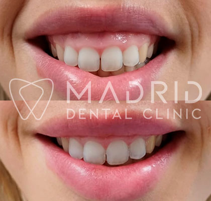 Corrección de sonrisa gingival con acido hialuronico en madrid