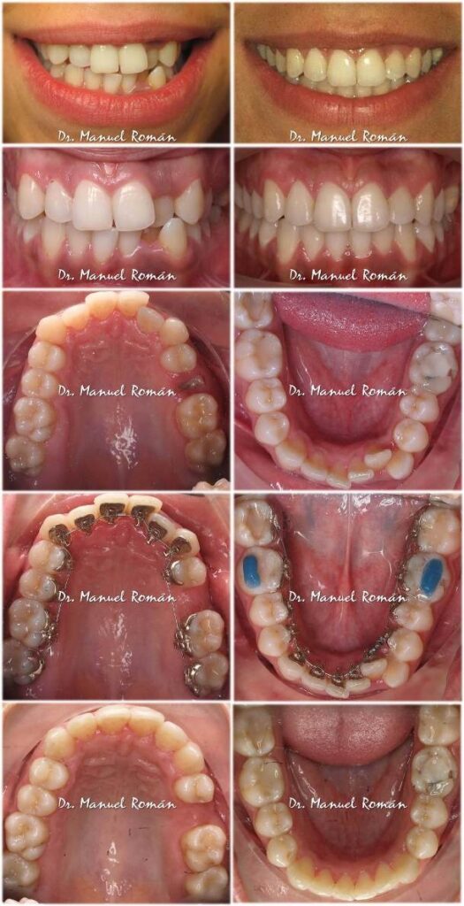 Antes y después de Apiñamiento Ortodoncia Lingual