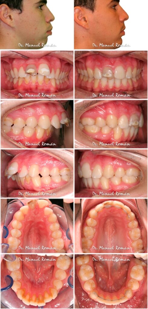 Antes y después Biprotrusion dental