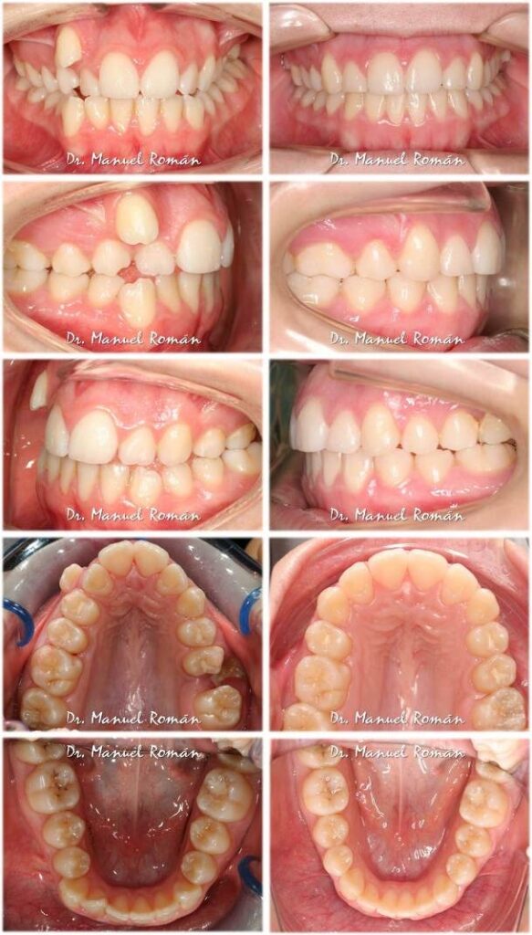 Antes y después Canino alto, anquilosis y asimetria