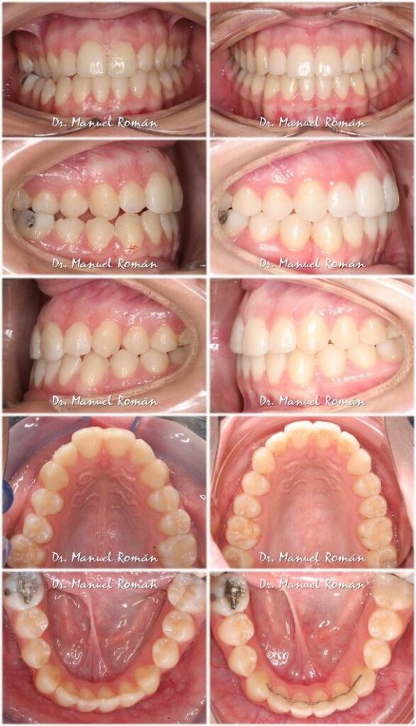 Antes y despues Clase III con mordida abierta y mordida cruzada
