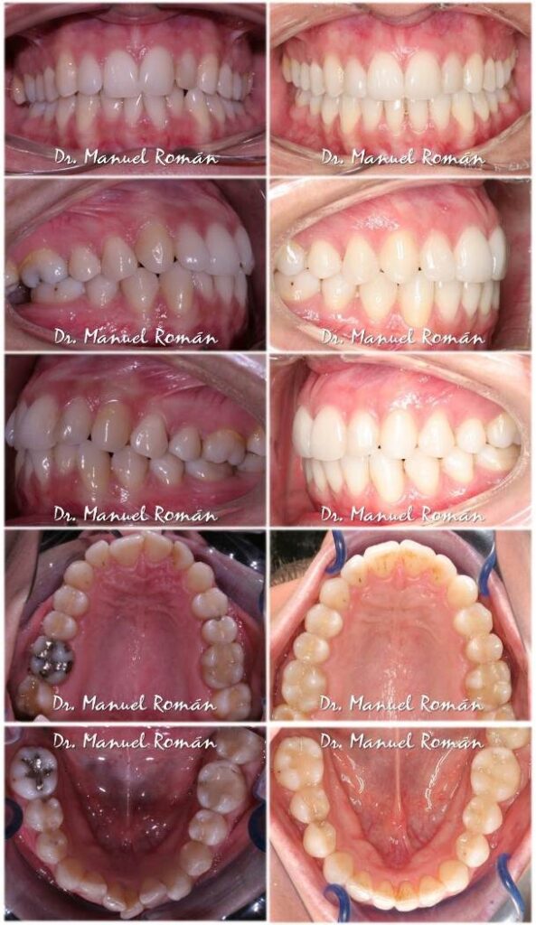 Antes y despues Dientes Apiñados