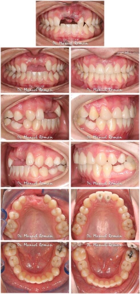 Antes y despues Implantes y ortodoncia