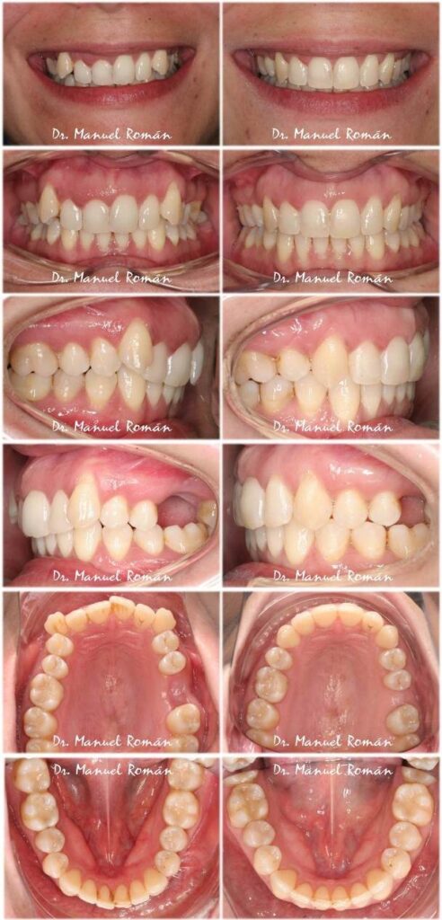 Antes y despues Invisalign Clase II con extracciones