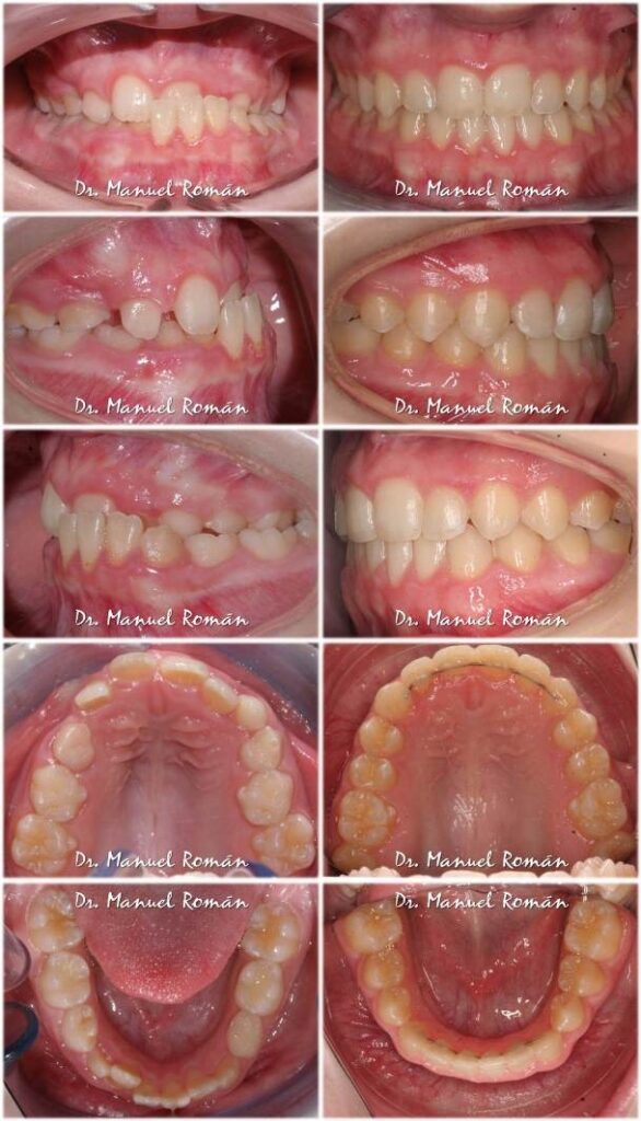 Antes y después Mordida Cruzada Anterior y posterior