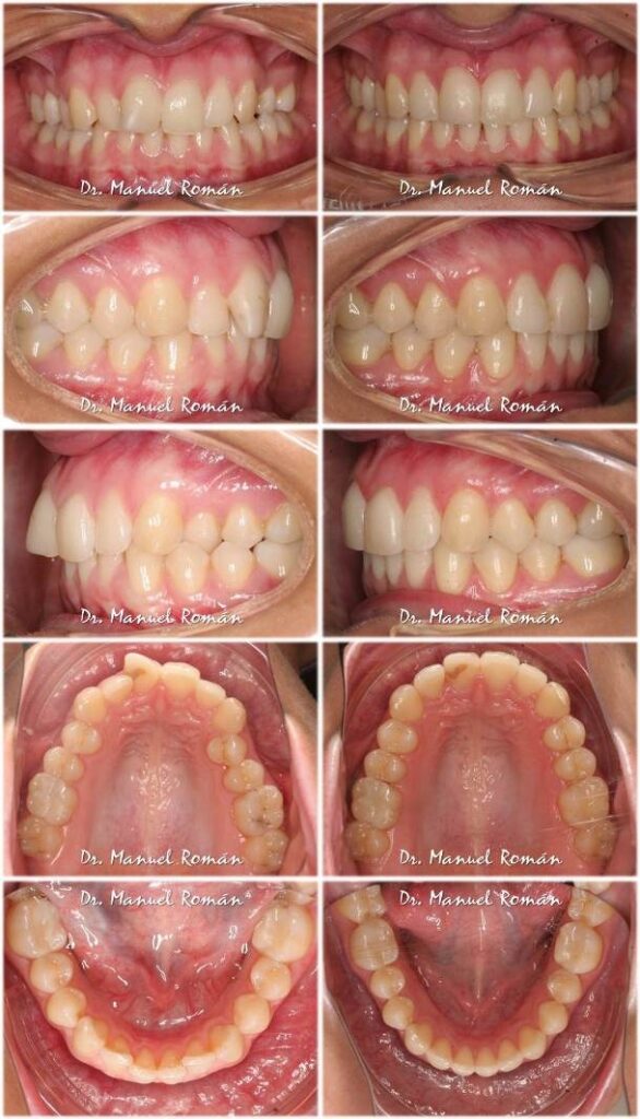 Antes y después Mordida Cruzada con Invisalign