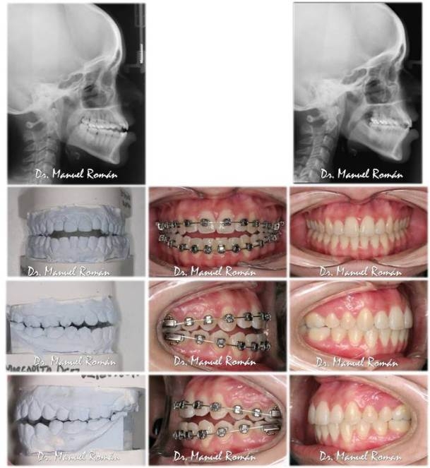 Antes y después Mordida abierta anterior