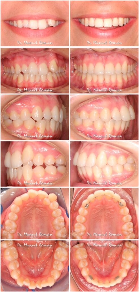 Antes y después Ortodoncia adulto sin extracciones