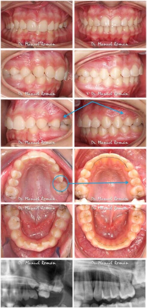 Antes y después Premolar incluido