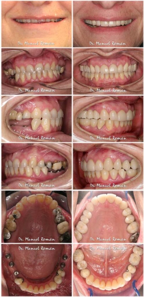 Antes y después Tratamiento Multidisciplinar Invisalign