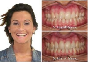 Mordida Cruzada con Invisalign