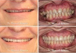 Tratamiento Multidisciplinar Invisalign