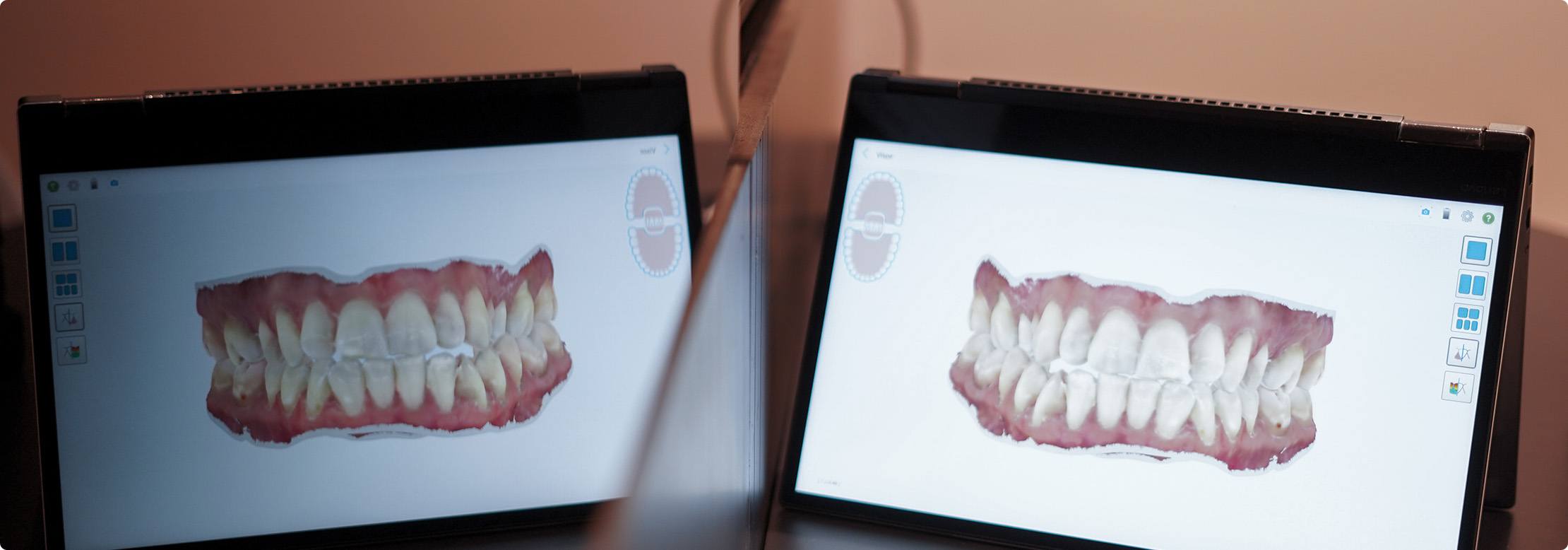Importado de ortodonciamadrid.madriddentalclinic.es Scanner intraoral de ortodoncia